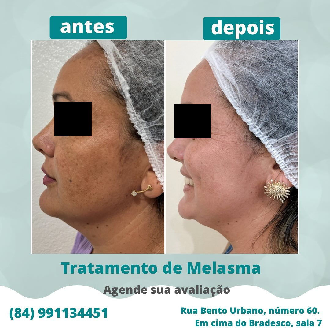 Caso de melasma cuidado - Foto 2
